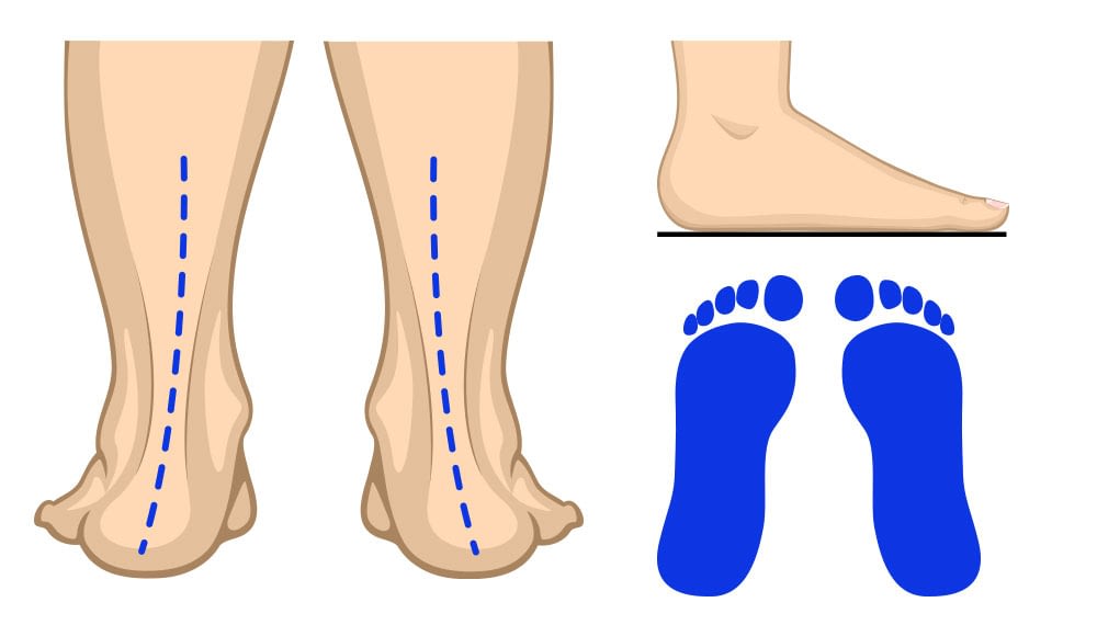 back to motion-Flat Feet