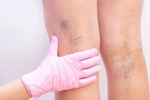 Compression stockings at Thornhill osteopathy clinic help reduce varicose vein pain by improving circulation, reducing swelling, and promoting better leg health.