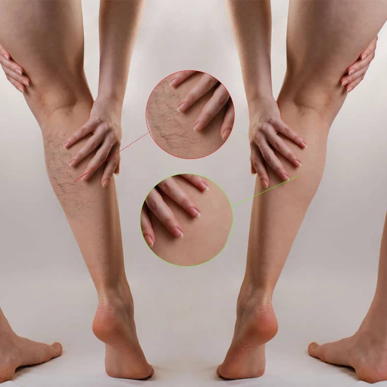 Compression stockings at Thornhill osteopathy clinic improve circulation and relieve leg pain, supporting better vascular health and mobility.